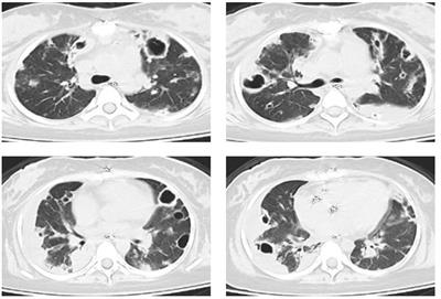 Incorporating electrical impedance tomography to transpulmonary pressure-guided PEEP in severe ARDS with pneumothorax and multiple cavitations: a case report